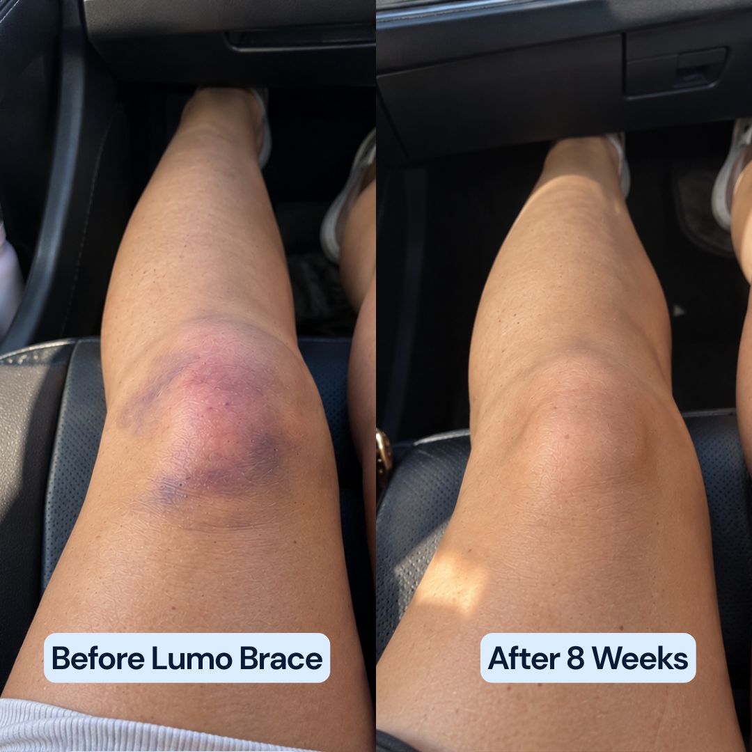 Customer's knee before using the LumoRelief Heat Therapy Brace showing visible swelling, compared to the same knee after 8 weeks of use showing reduced swelling